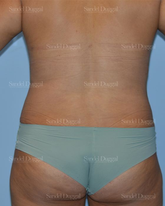 Liposuction — Legs & Flanks after, case 2520