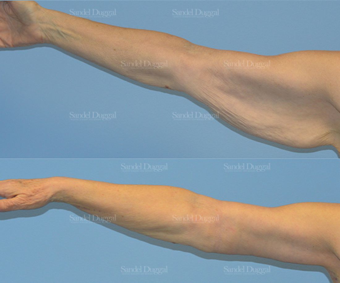 Brachioplasty before and after, case 2150