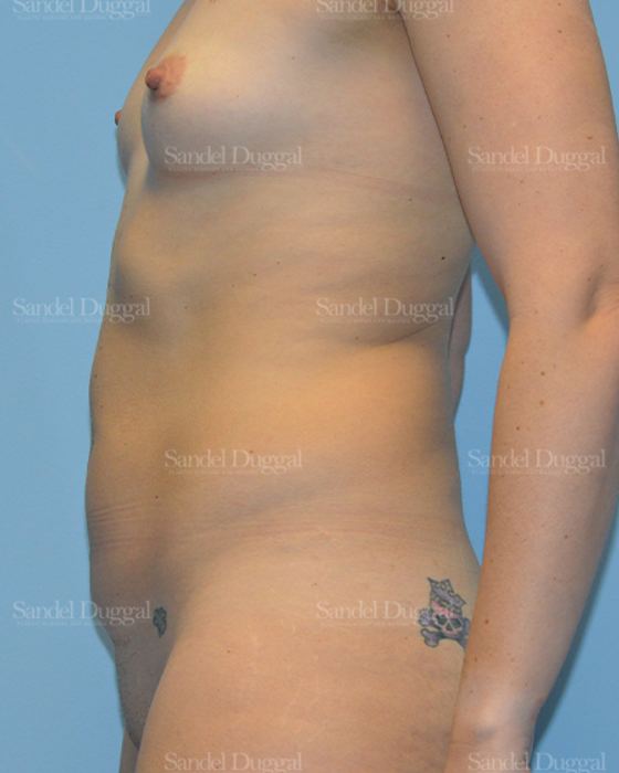 Mommy Makeover before, case 785