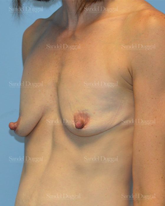 Breast Augmentation with Lift before, case 3400
