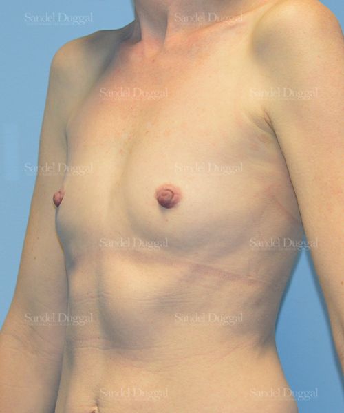 Breast Augmentation before, case 3241
