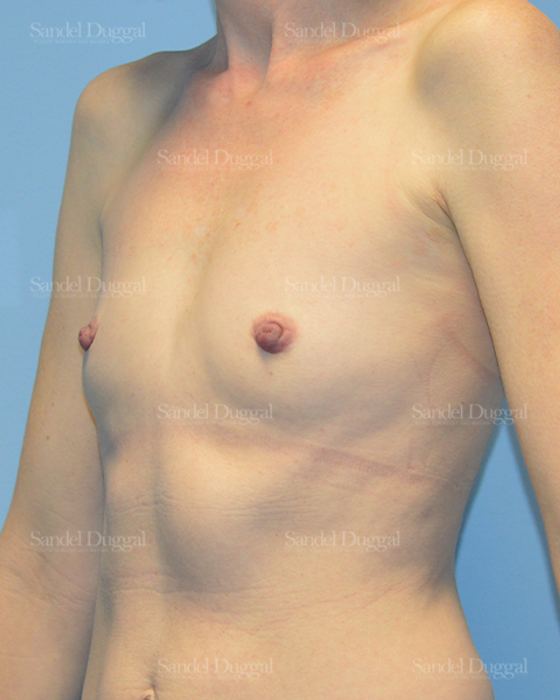 Breast Augmentation before, case 3241