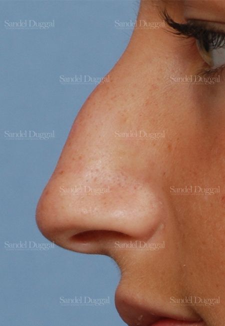 Rhinoplasty before, case 2876