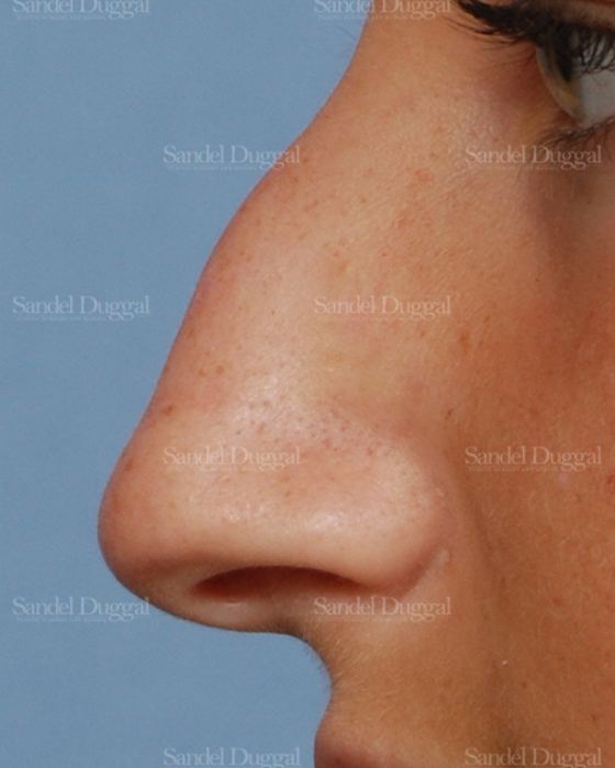 Rhinoplasty before, case 2876