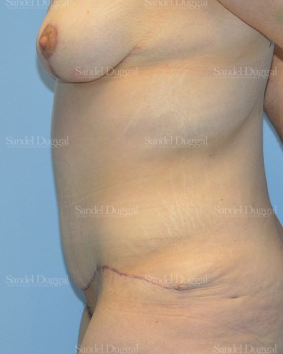 Mommy Makeover after, case 2183