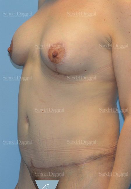 Mommy Makeover after, case 2211
