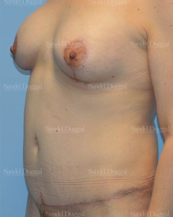 Mommy Makeover after, case 2211