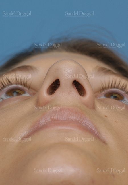 Rhinoplasty before, case 2885