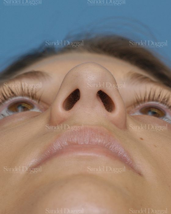 Rhinoplasty before, case 2885