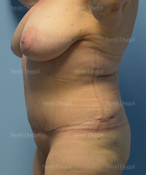 Tummy Tuck after, case 1566