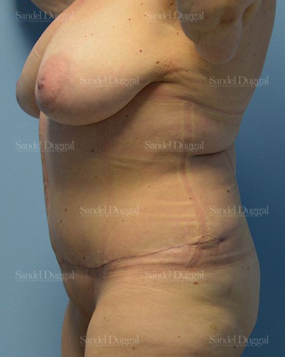 Tummy Tuck after, case 1566