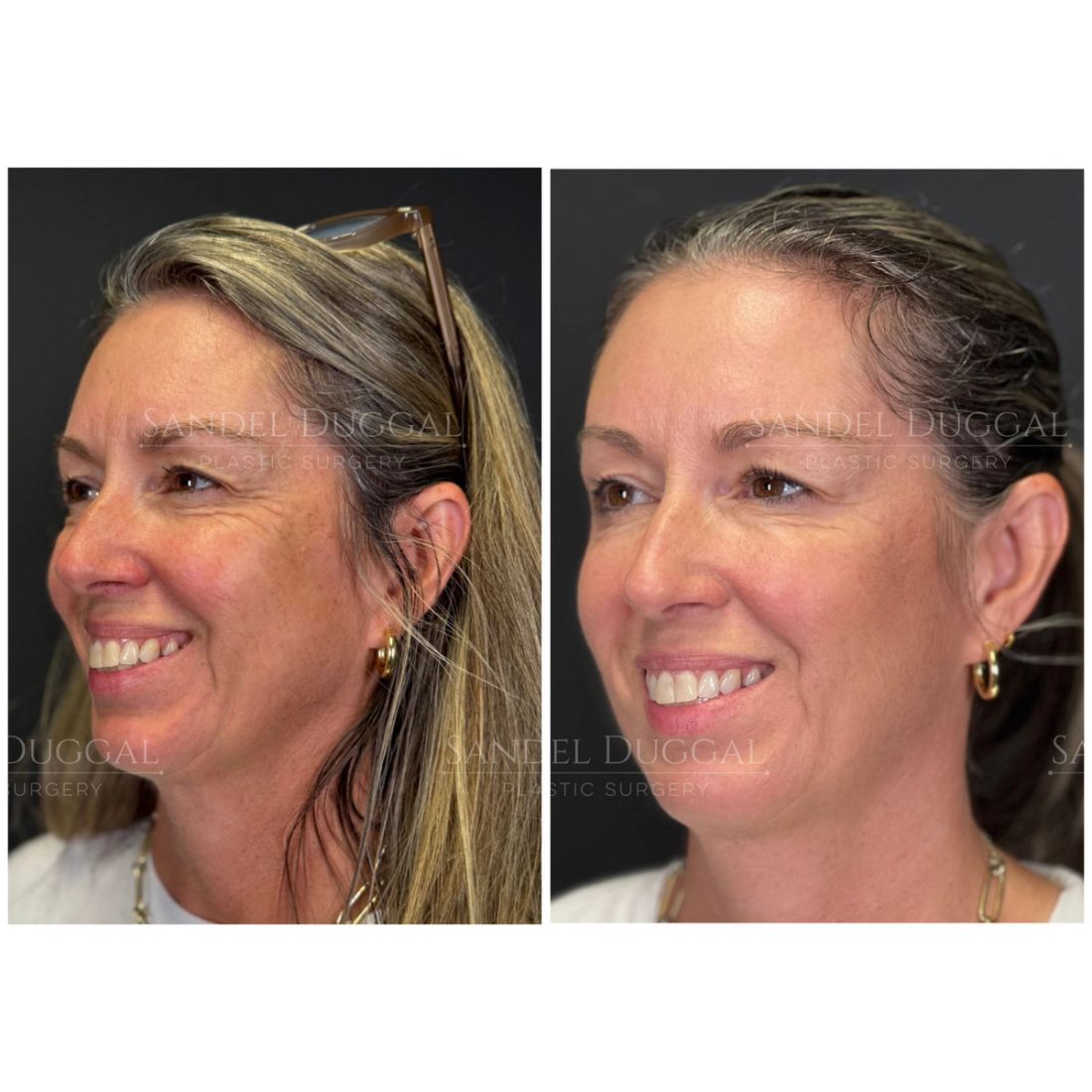 Botox & Fillers before and after, case 6008