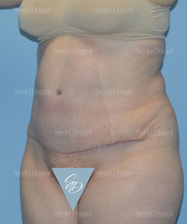 Tummy Tuck after, case 1666
