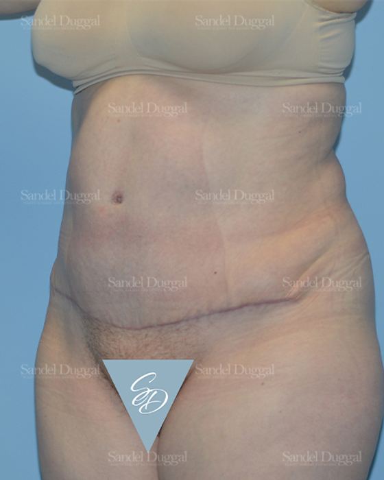 Tummy Tuck after, case 1666