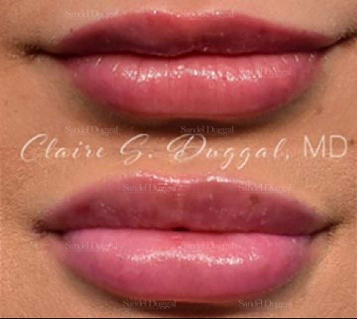 Lip Augmentation / Lip Lift before and after, case 4379