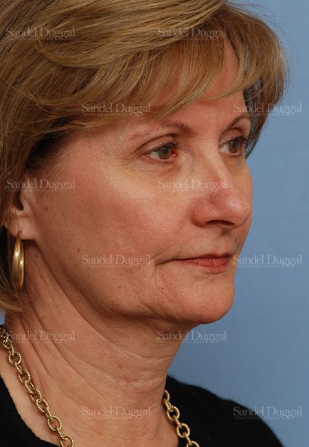 Facelift before, case 2702