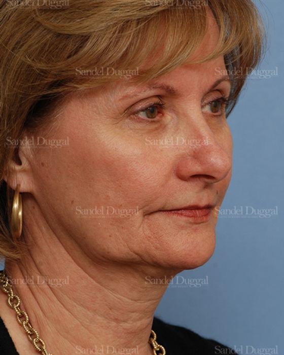 Facelift before, case 2702