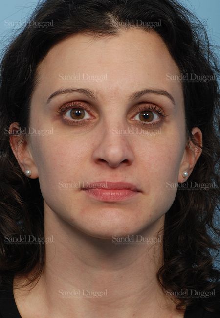Rhinoplasty after, case 2831