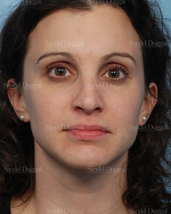 Rhinoplasty after, case 2831