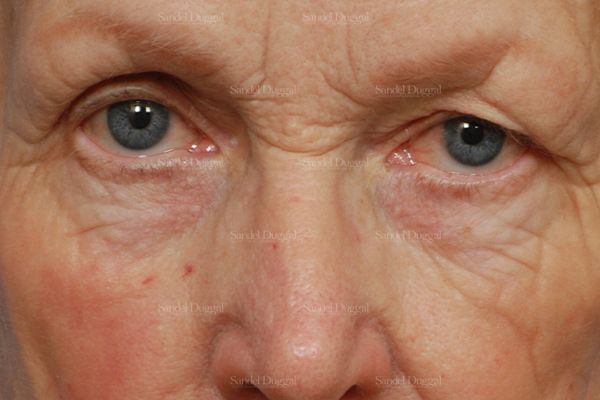 Eyelid Rejuvenation before, case 1951