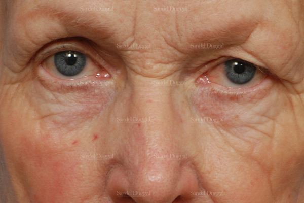 Eyelid Rejuvenation before, case 1951