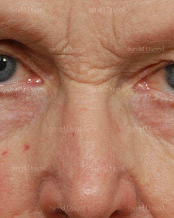 Eyelid Rejuvenation before, case 1951