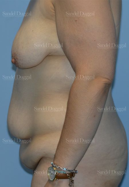 Mommy Makeover before, case 2183