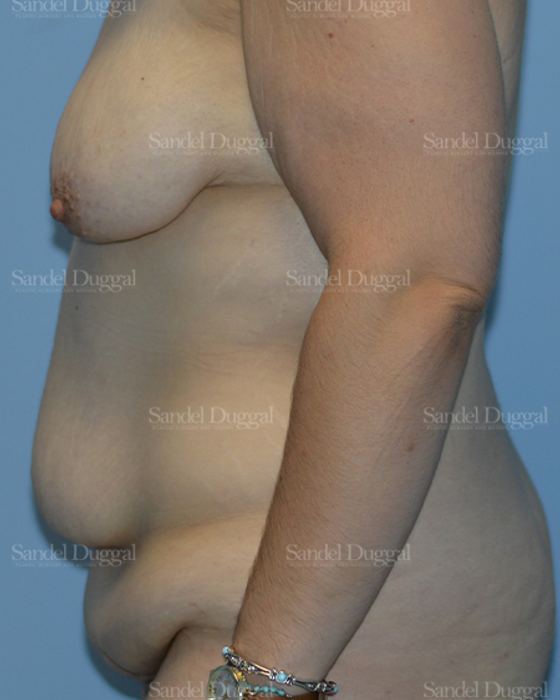 Mommy Makeover before, case 2183