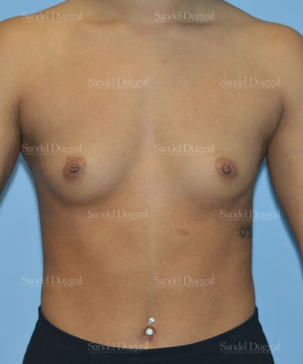 Breast Augmentation before, case 3164