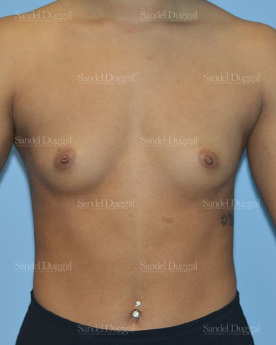 Breast Augmentation before, case 3164