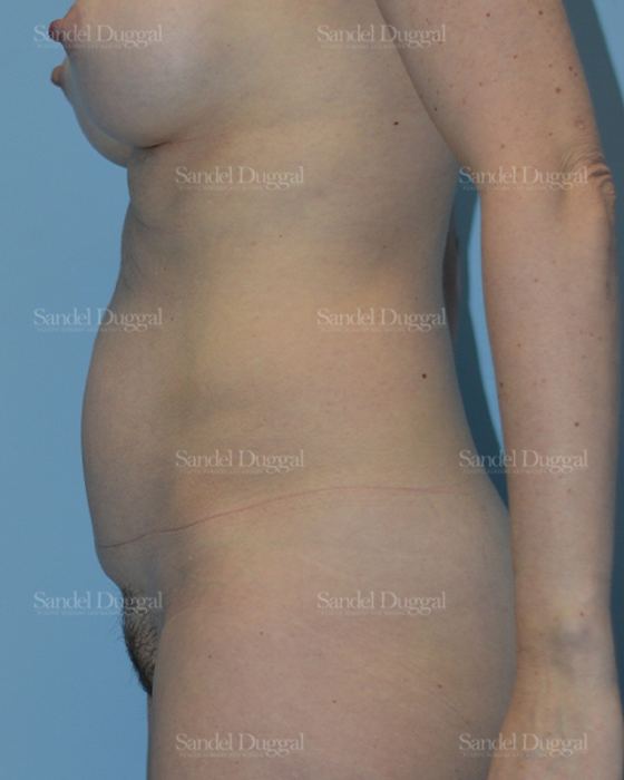 Tummy Tuck before, case 1652