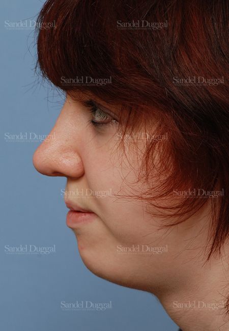 Rhinoplasty after, case 2826