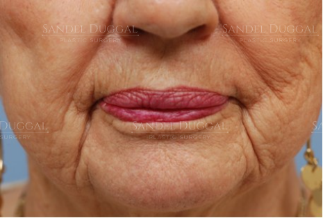 Lower Lip Advancement before, case LLA-1