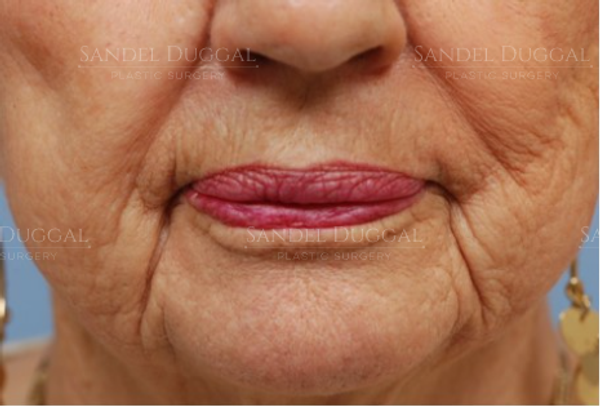 Lower Lip Advancement before