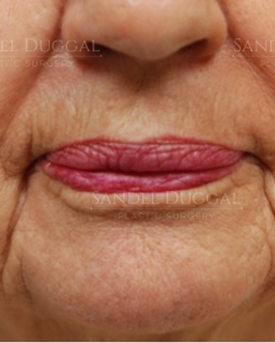 Lower Lip Advancement before, case LLA-1