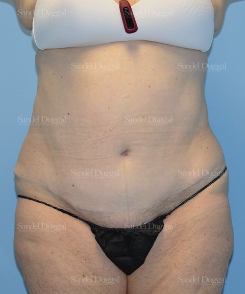 Liposuction — Abdomen before, case 2464