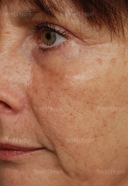 Laser Skin Resurfacing before, case 2966