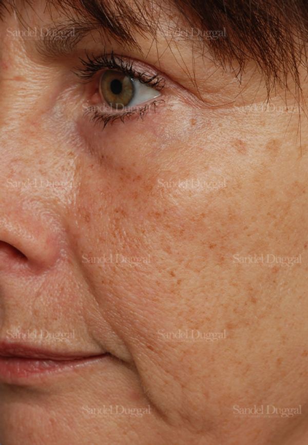 Laser Skin Resurfacing before, case 2966