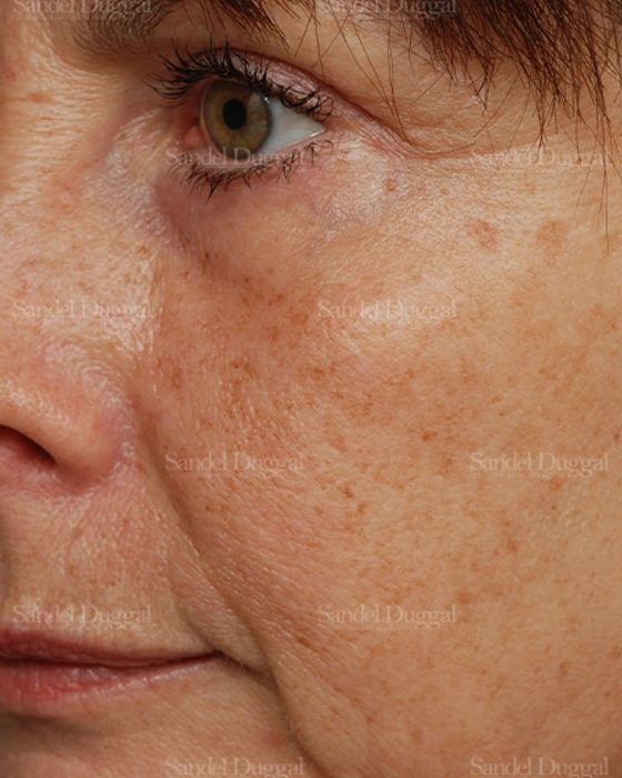 Laser Skin Resurfacing before, case 2966