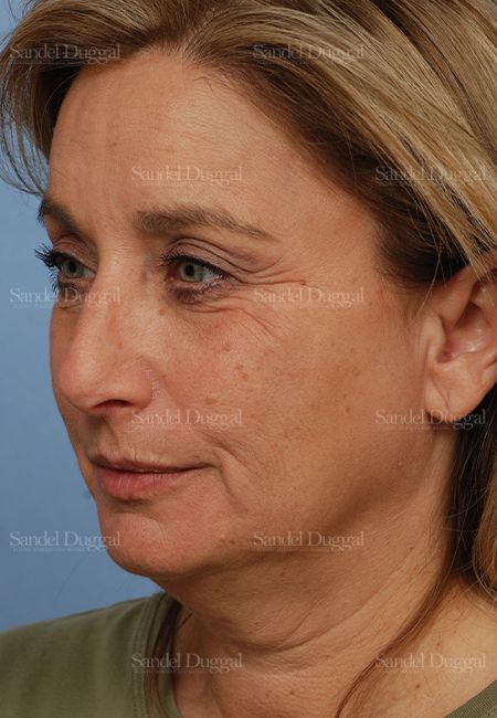 Facelift before, case 2714