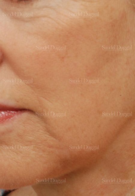 Laser Skin Resurfacing after, case 2978