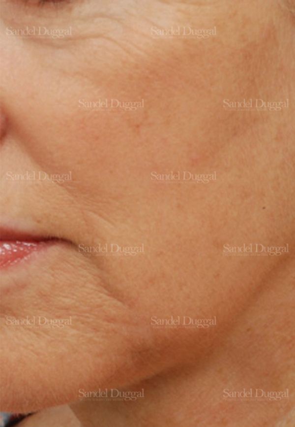 Laser Skin Resurfacing after, case 2978