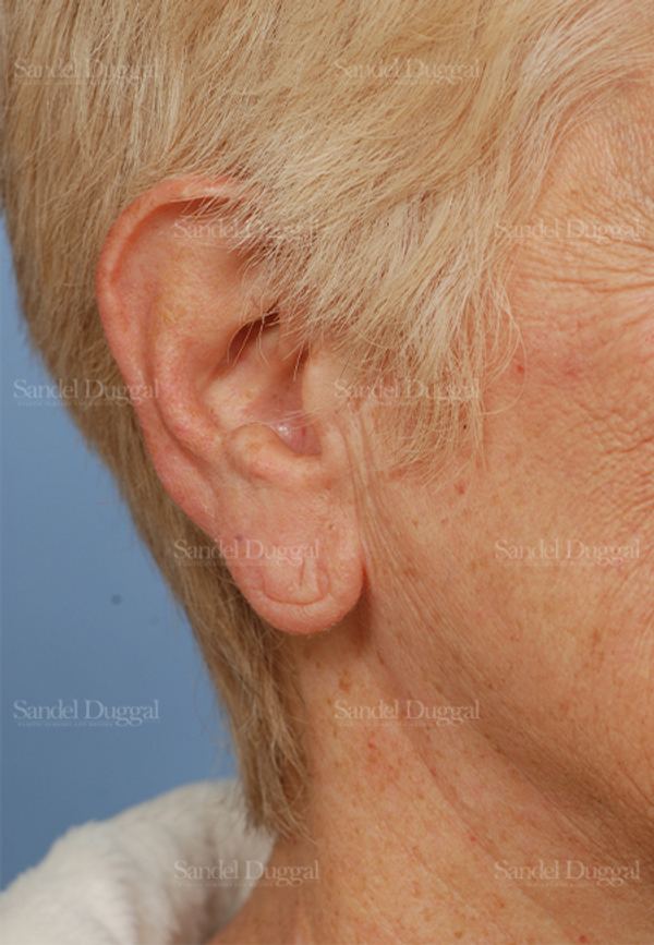 Earlobe Repair before, case 2573
