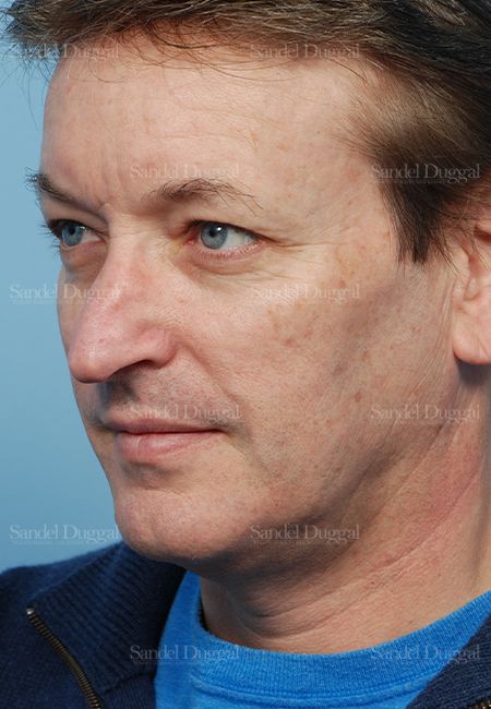 Rhinoplasty before, case 2838