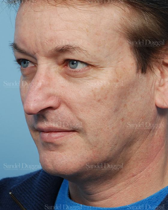 Rhinoplasty before, case 2838