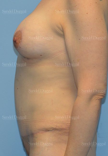 Mommy Makeover after, case 2211