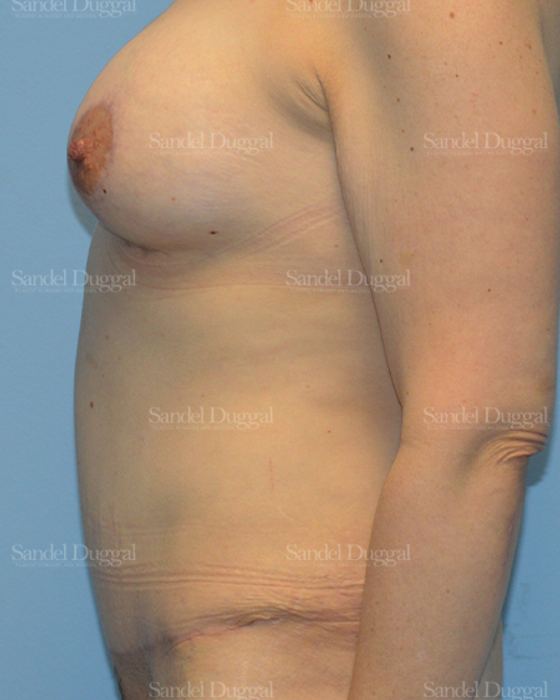 Mommy Makeover after, case 2211