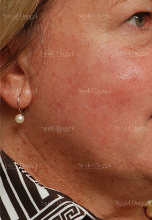 Reconstruction after Mohs after, case 2724
