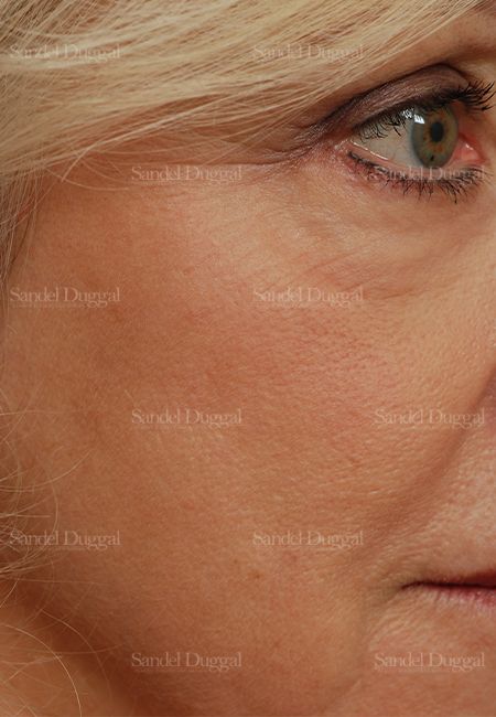 Laser Skin Resurfacing after, case 2944