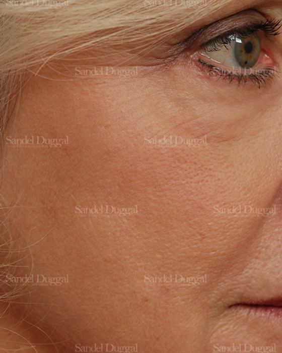 Laser Skin Resurfacing after, case 2944